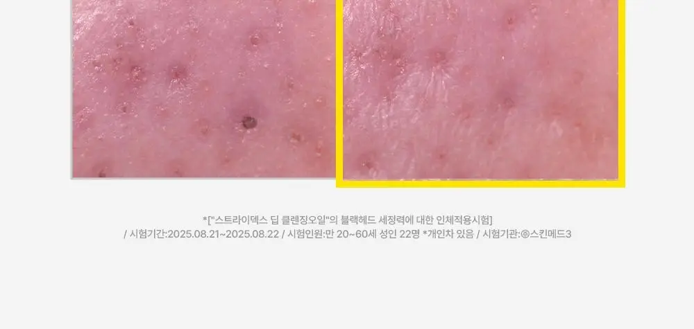 [놓치면끝] 스트라이덱스 포어 리셋 딥 클렌징오일 200ml 상세페이지 19